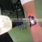 Facial Veins Treatment Low Price Q-Switched Nd:YAG Laser Tatoo Removal Machine By QTS Naevus Of Ito Removal