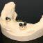 Dental Telescope Denture, Telesope Crown, Dental Prosthesis, Laboratoire Dentaire, Dentallabor, Laboratorio Dental, Dental Laboratory, Shenzhen LJ Dental Lab China