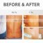 2020 GSD Discount Vitiligo Treatment Machine UVB Lamps For Psoriasis Skin