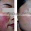 Professional and popular lipolysis spider vein removal