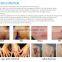 Home Tattoo Laser Machine Medical Laser 1 HZ Tatoo Removal Brown Age Spots Removal