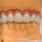 China Screw Retained Implant BridgeGood quality comes initial