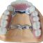 Dental laboratory dental restorations xztitanium alloy 3d printed partial framework dentures