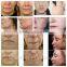 professional microneedle rf/best rf skin tightening face lift machine/micro rf deep wrinkle removal