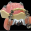 Implant retention stabilizes denture Bar Overdenture on Implant