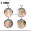 ipl shr laser machine hair removal & skin rejuvenation with shr 1550 handle for fast hair