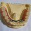 Expander Orthodontic in China Dental Lab