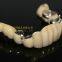 Telesope Crown, Dental Telescope Denture, Dental Prosthesis, Laboratoire Dentaire, Dentallabor, Laboratorio Dental, Dental Laboratory, Shenzhen LJ Dental Lab China