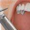 Dental Diamond Burs for dental surgeries polishing miya@moresuperhard.com