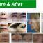 Professional RF Tube Laser Generator Vaginal Tightening Laser CO2 Fractional