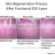 Ultra Pulse Spot Scar Pigment Removal Skin Rejuvenation Fractional CO2 Ultra Pulse Laser Machine Beauty Equipment Birth Mark Removal