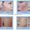 980nm laser Spider Vein Removal machine for sale