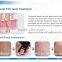 Ultra pulse Pigmentation Removal CO2 laser resurfacing machine
