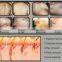 big energy 10 germany laser bars 808 diode laser hair removal machine price