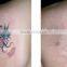 q switched nd yag laser beauty skin care equipment for tattoo removal