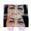Hotsale always CDT carboxytherapy instrument, CDT carboxytherapy