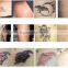 Brown Age Spots Removal Bestview BM208Tattoo Removal Nd Yag Long Pulse Laser Haemangioma Treatment