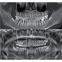 Dental 3D CBCT, Dental panoramic CBCT 3D