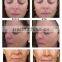 High Intensity Focused Ultrasound 2016 New High Intensity Focused Ultrasound HIFU HIFU Machine Forehead Wrinkle Removal