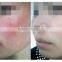 Big Discount! Top Quality Laser Spider Vein Machine / Skin Tag Removal Machine on Sale