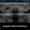 Echocardiography Color Doppler Ultrasound Scanner