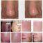 spa used high efficiency laser diode 980nm spider vein removal machine