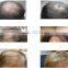 diode laser hair loss therapy machine hair growth treatment beauty salon equipment supplier