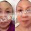 Broadlaser ultrasonic face lift machine home