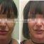 latest technology HIFU face lift beauty machine for anti aging wrinkle removal