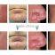 Immediately Result Spider Vein Removal Varicose Veins Laser Treatment Machine/ Vascular Surgical Instruments
