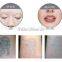safety medical ce approved High quality q switched nd yag laser