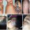 Unique Q Switch Nd Haemangioma Treatment Yag Laser Tattoo Removal Q Switch Laser Tattoo Removal