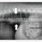 Xray film 14*17inch blue based China Manufacture