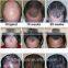 650nm Diode laser hair growth beauty equipment for hair regrowth hair loss therapy