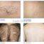 Home Use 808nm Diode Laser Hair Removal Portable Diodenlaser Machine