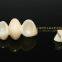 Dental crown e.Max ceramic, porcelain crown, dental veneers, laboratoire dentaire, Dentallabor, laboratorio dental, dental laboratory, Shenzhen LJ dental lab China