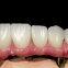 Chinese Dental Lab-Denture Droichead Zirconia - Saotharlann Fiaclóireachta MYY