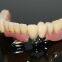 Dental Telescope Denture, Telesope Crown, Dental Prosthesis, Laboratoire Dentaire, Dentallabor, Laboratorio Dental, Dental Laboratory, Shenzhen LJ Dental Lab China
