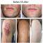 High effective solution 308nm excimer uvb laser vitiligo treatment device for psoriasis and vitiligo