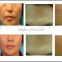 Improving skin-elasticity and skin-shine fractional rf thermagic/Fractional rf needle beauty device