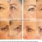 10600nm Skin Resurfacing Sanhe Fractional Laser Co2 Medical Skin Tightening System/ Laser Machine Dermatology Professional