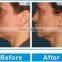 2016 Newest Technology Hifu Pigment Removal Face Lift And Corporal Machine Expression Lines Removal