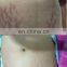 Fractional Co2 Laser System With Scanner Facial Wrinkle Acne Scar Removal Skin Surfacing Equipment