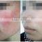 distributors wanted 980nm medical diode laser/980nm diode laser spider vien