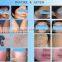 Haemangioma Treatment ND Yag Laser Tattoo Removal /home Use Tattoo Vascular Tumours Treatment Removal Machine/laser ND Yag For Skin Rejuventation Vascular Removal Age Spot 1 HZ