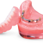 Implant retention stabilizes denture Bar Overdenture on Implant