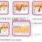 KLSI 808nm laser hair removal laser /hair removal machine price in india