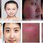 EVLT Laser Spider Vein Removal 980 nm Diode Laser for Whole Body Vascular Lesion Removal