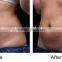 5.0-25mm 2016 Non-surgical Body Liposonix Fat Reduction Korea High Pain Free Intensity Focused Ultrasound Slimming Hifu Machine For Body Shaping Nasolabial Folds Removal