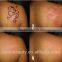 hot sale nd yag laser tattoo removal/best laser tattoo removal/fast effect nd yag tattoo laser